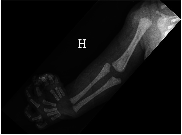 Ulnar dimelia - a review of 24 cases.