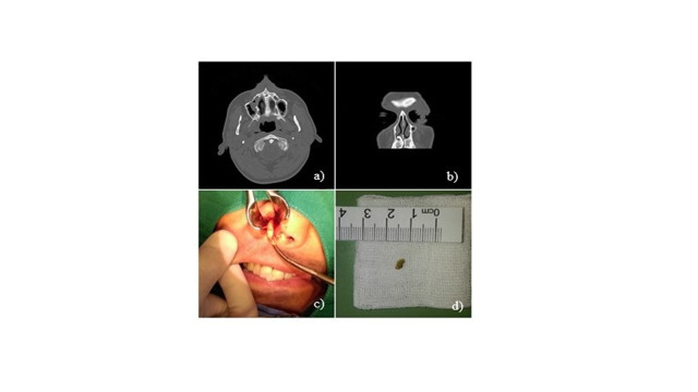 Intranasal supernumerary tooth: two case reports and review of the literature.