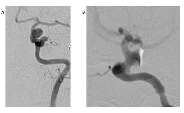 Efficacy of Flow Diverters in Managing Multiple Aneurysms: A Clinical Case Report.