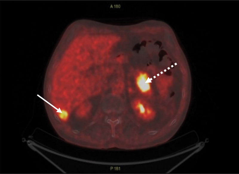 Endoscopic ultrasound-guided fine-needle aspiration using the bronchial ultrasound scope (EUS-B-FNA) for diagnosing pancreatic metastasis in a lung cancer patient case report.