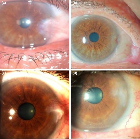 Twelve-Month Results of Pterygium Surgery with Autologous Blood Assisted, Sutureless Conjunctival Autograft: Safe and Comfortable Surgical Technique.