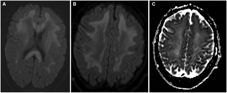 The dangers of "Chasing the dragon": a fatal case of heroin-induced leukoencephalopathy.