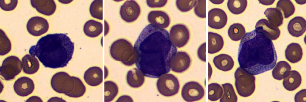 MPO Expression of Background Neutrophils in MPO Negative Acute Promyelocytic Leukemia, An Easy Clue to Corroborate a Challenging Diagnosis: A Case Report and Review of Literature.