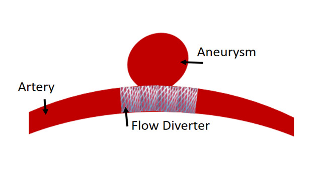 Efficacy of Flow Diverters in Managing Multiple Aneurysms: A Clinical Case Report.