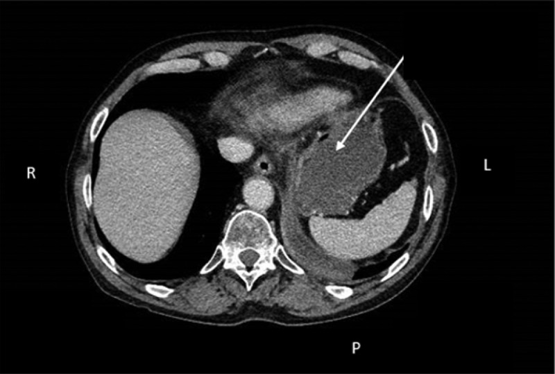 Endoscopic ultrasound-guided fine-needle aspiration using the bronchial ultrasound scope (EUS-B-FNA) for diagnosing pancreatic metastasis in a lung cancer patient case report.
