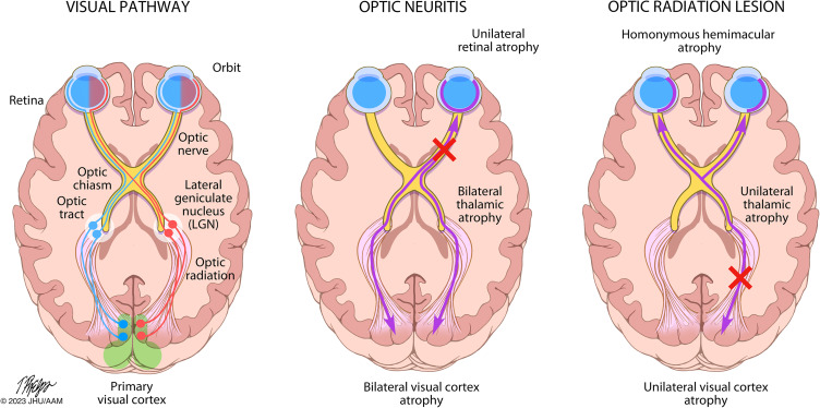 Spotlight on Trans-Synaptic Degeneration in the Visual Pathway in Multiple Sclerosis.