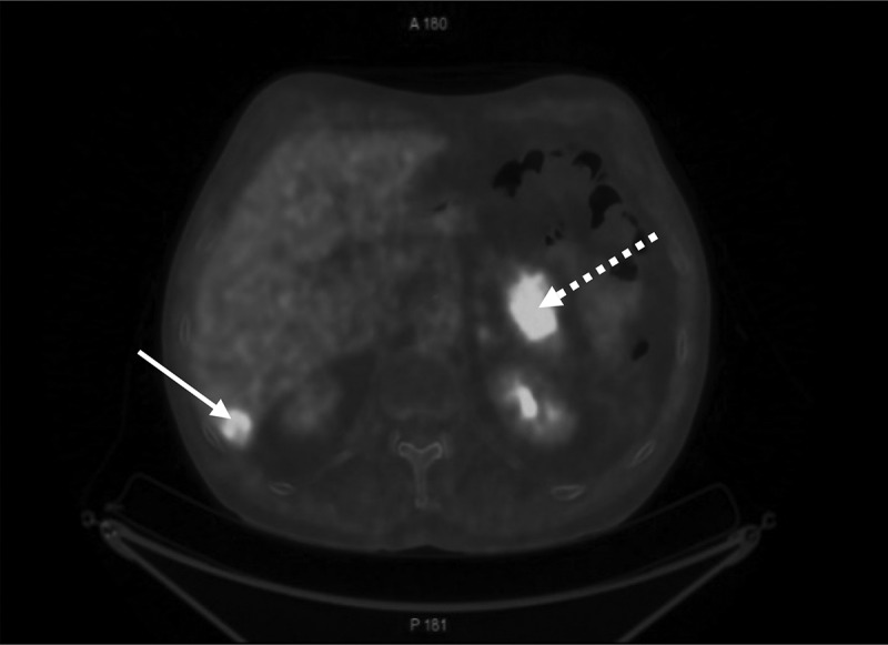 Endoscopic ultrasound-guided fine-needle aspiration using the bronchial ultrasound scope (EUS-B-FNA) for diagnosing pancreatic metastasis in a lung cancer patient case report.