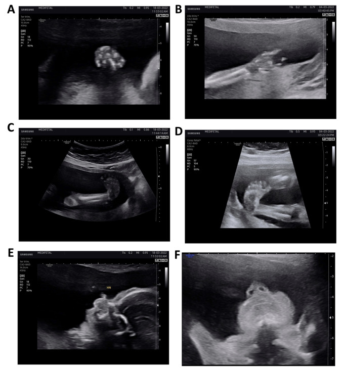 Prenatal diagnosis of Freeman-Sheldon syndrome using ultrasound and genetic testing. Case report