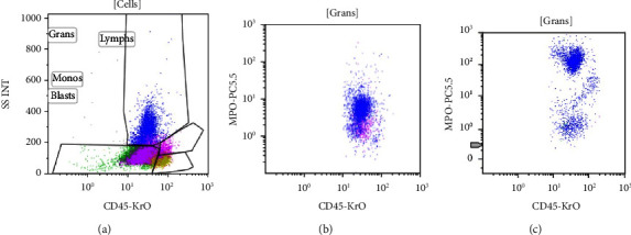 MPO Expression of Background Neutrophils in MPO Negative Acute Promyelocytic Leukemia, An Easy Clue to Corroborate a Challenging Diagnosis: A Case Report and Review of Literature.