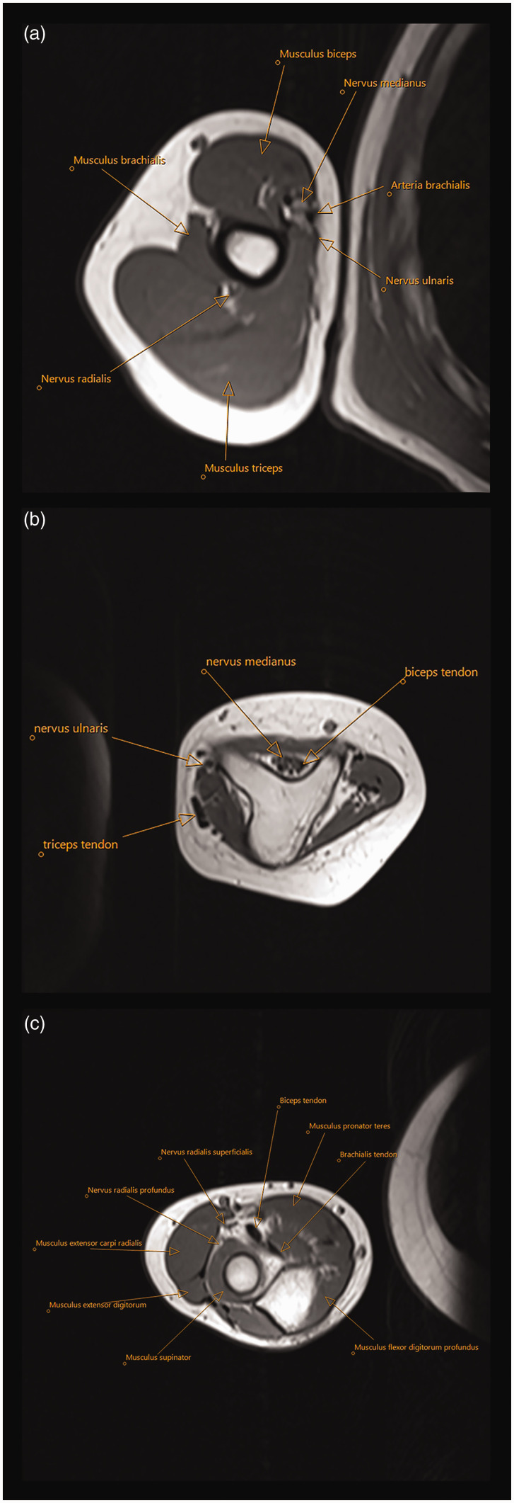 Ulnar dimelia - a review of 24 cases.