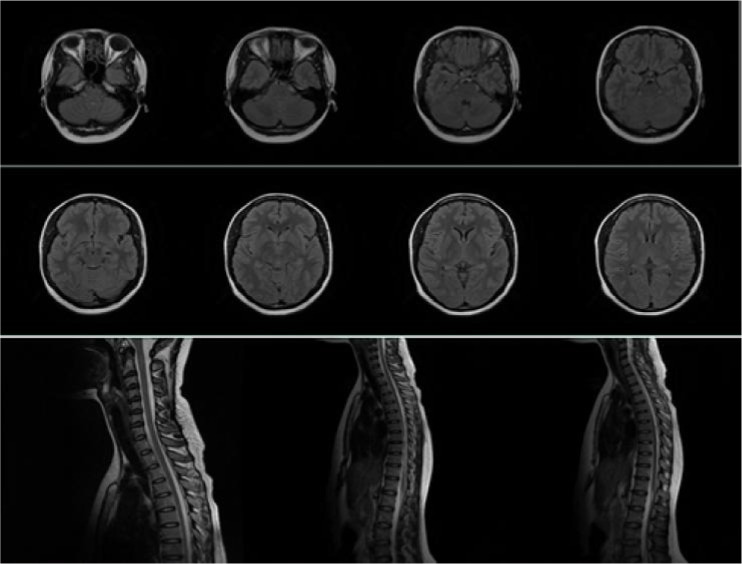 AQUAPORIN-4 (AQP-4) IMMUNOGLOBULIN G SEROPOSITIVE NEUROMYELITIS OPTICA: A REVIEW AND CASE REPORT.