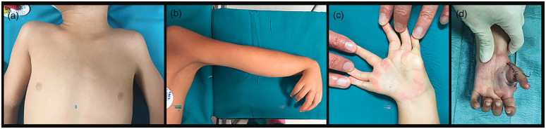 Ulnar dimelia - a review of 24 cases.