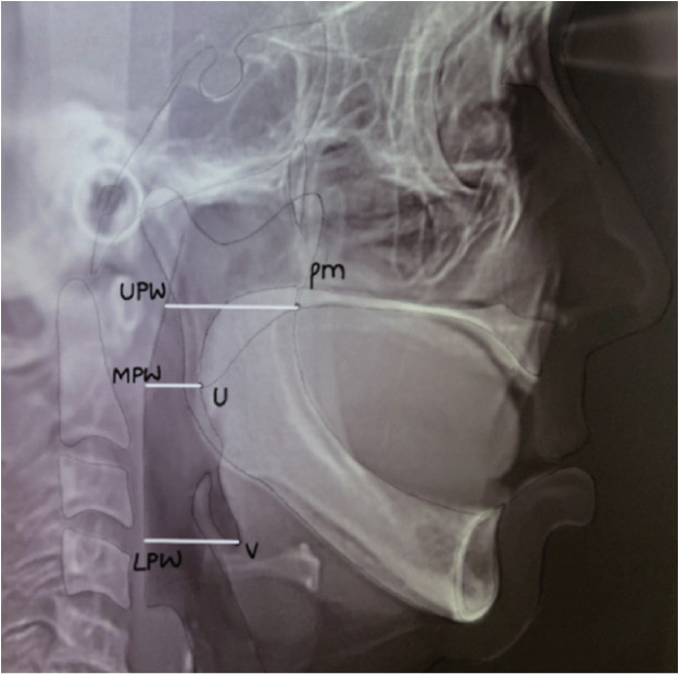 Effect of Prosthetic Rehabilitation on Airway Space in Edentulous Patients with Obstructive Sleep Apnea- a Preliminary Observational Study.