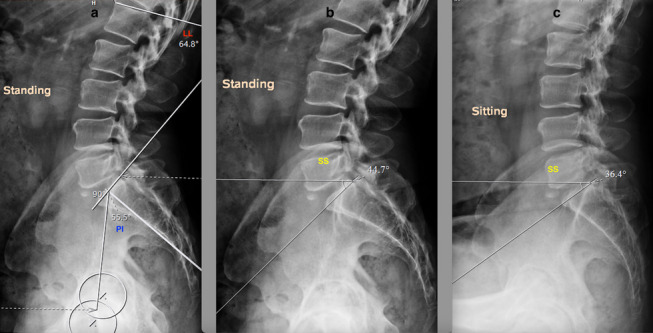 Acetabular cup positioning in primary routine total hip arthroplasty-a review of current concepts and technologies.