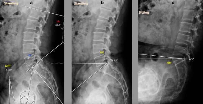 Acetabular cup positioning in primary routine total hip arthroplasty-a review of current concepts and technologies.