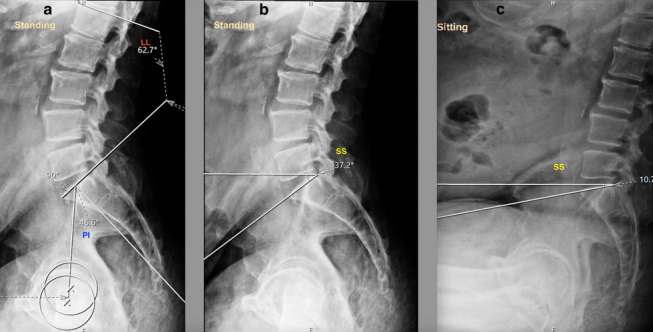 Acetabular cup positioning in primary routine total hip arthroplasty-a review of current concepts and technologies.