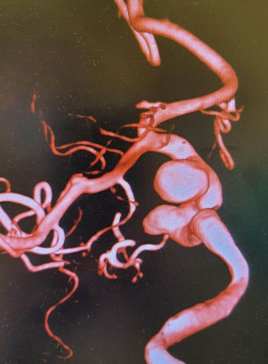 Efficacy of Flow Diverters in Managing Multiple Aneurysms: A Clinical Case Report.