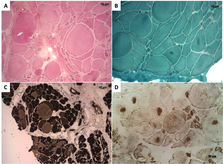 Skeletal muscle involvement in biallelic <i>SORD</i> mutations: case report and review of the literature.