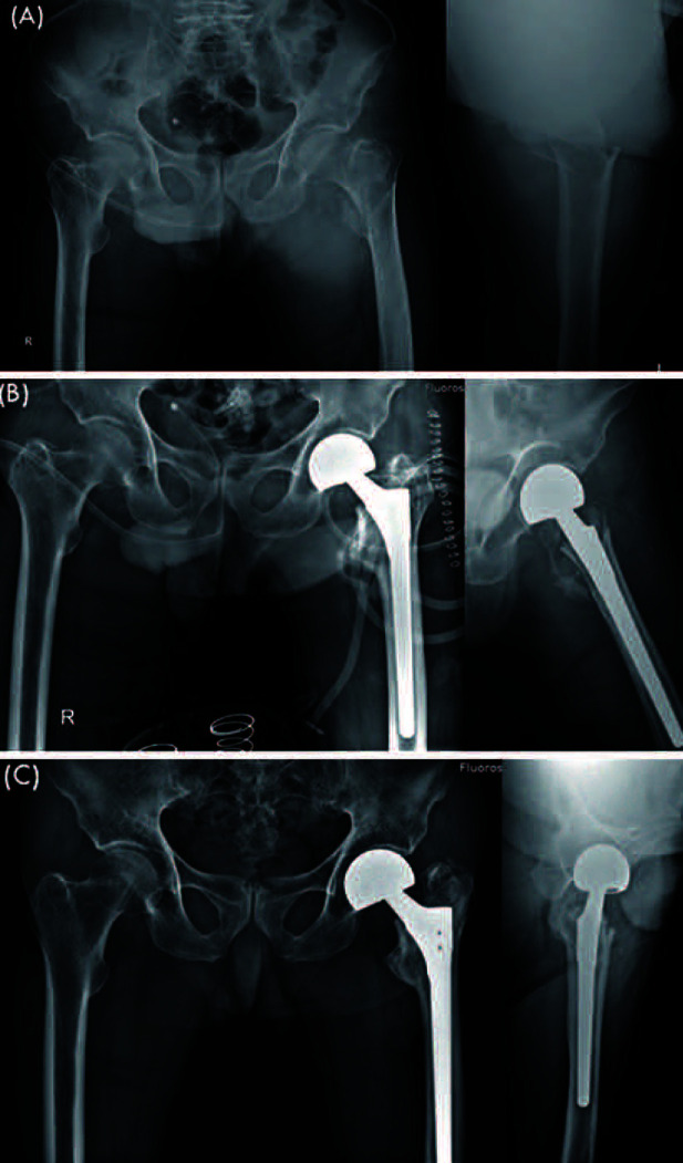 A Comparative Study of Bipolar Hemiarthroplasty for Intertrochanteric Fracture: Direct Anterior Approach versus Conventional Posterolateral Approach.