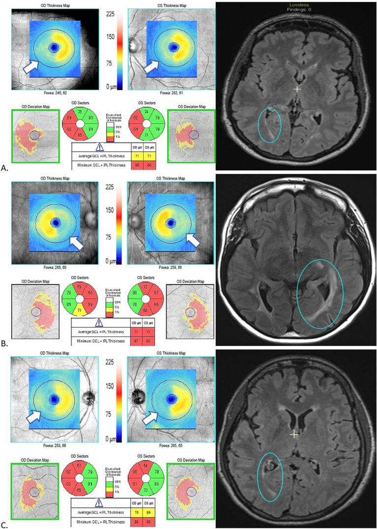 Spotlight on Trans-Synaptic Degeneration in the Visual Pathway in Multiple Sclerosis.