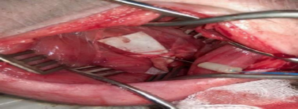 Smart needle electrical bioimpedance to provide information on needle tip relationship to target nerve prior to local anesthetic deposition in peripheral nerve block (USgPNB) procedures.