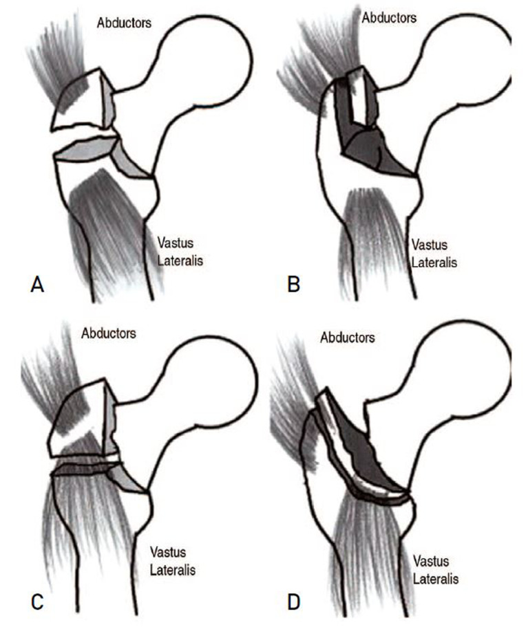A Comparative Study of Bipolar Hemiarthroplasty for Intertrochanteric Fracture: Direct Anterior Approach versus Conventional Posterolateral Approach.
