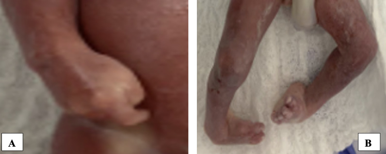 Prenatal diagnosis of Freeman-Sheldon syndrome using ultrasound and genetic testing. Case report