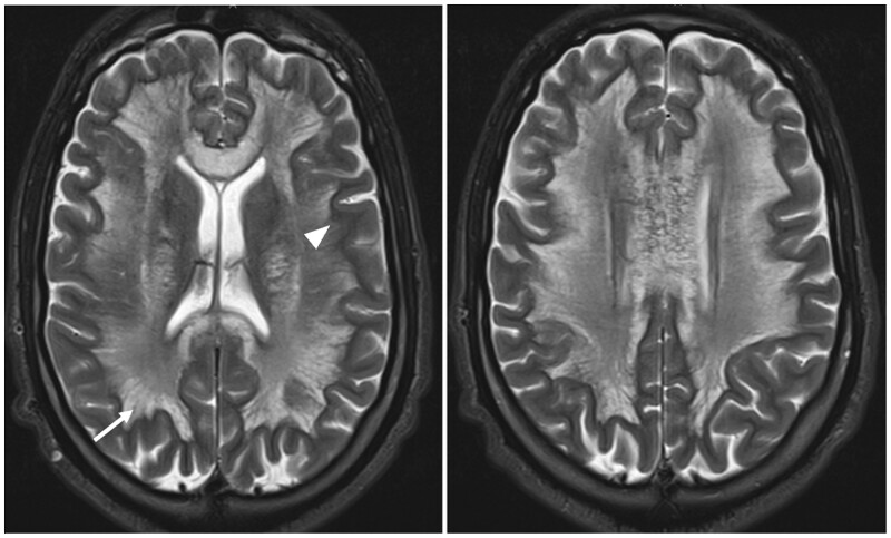 The dangers of "Chasing the dragon": a fatal case of heroin-induced leukoencephalopathy.