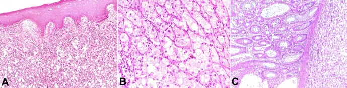 Anorectal balloon cell melanoma: a rare variant.