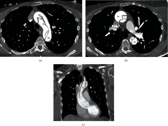 Spontaneous Extensive Type A Aortic Dissection in an Older Female with No Risk Factors: A Rare Clinical Presentation.