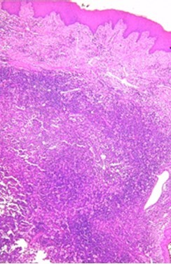 Rosai-Dorfman disease of the oral cavity.