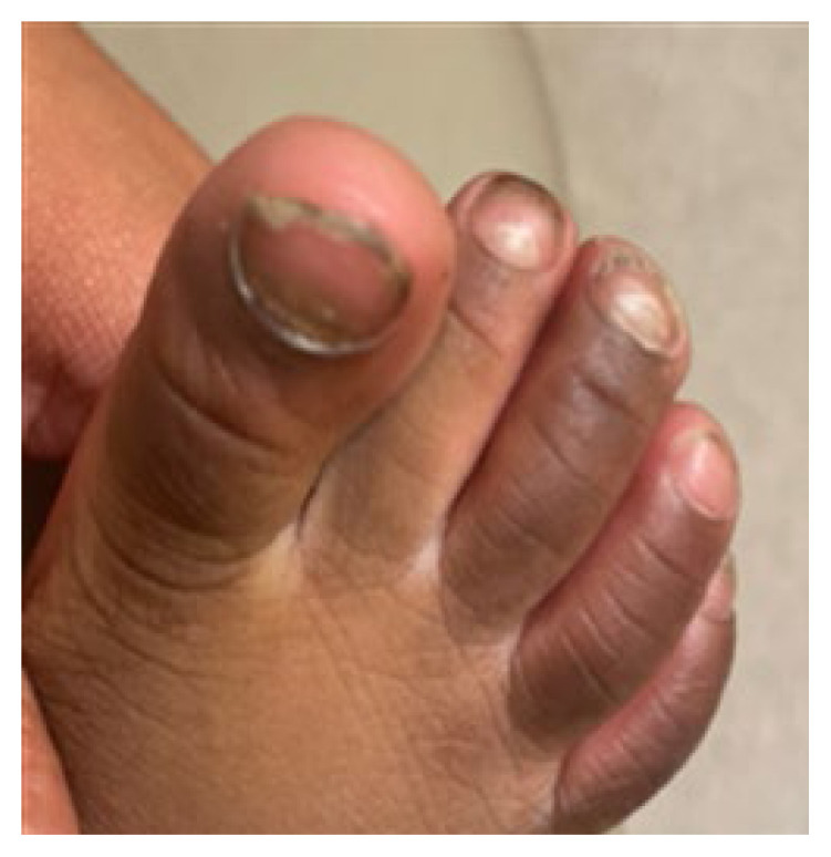 Common Post-Viral Sequalae: Onychomadesis in Setting of Giannoti Crosti Syndrome.