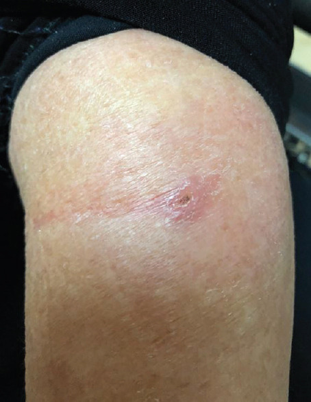 Self-administration of herbal treatment for periocular cutaneous leishmaniasis: A case report and systematic review.