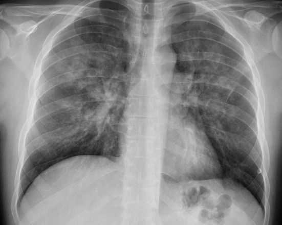 Diffuse alveolar hemorrhage following inhaled sevoflurane: A rare complication of inhalational anesthesia.
