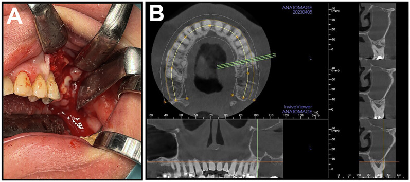 Role of Actinomyces spp. and related organisms in the development of medication-related osteonecrosis of the jaw (MRONJ): Clinical evidence based on a case series.