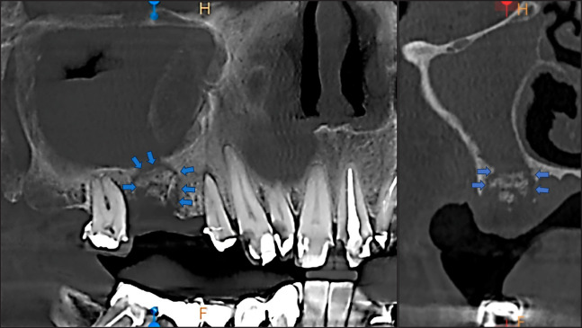A Case Report of Ibandronic Acid Induced Non-Exposed BRONJ Involving the Maxillary Sinus.