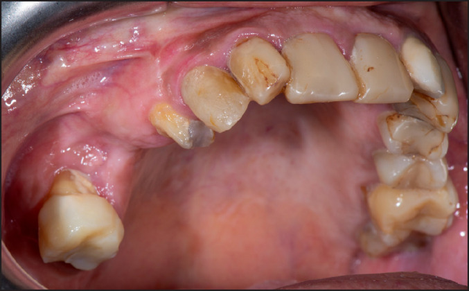A Case Report of Ibandronic Acid Induced Non-Exposed BRONJ Involving the Maxillary Sinus.