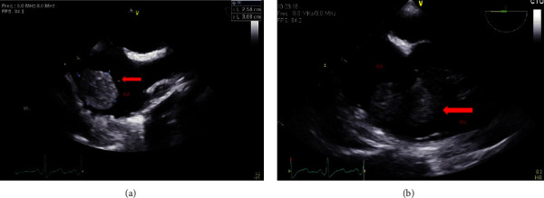 Migration of an Inferior Vena Cava Tumor Thrombus during Renal Cell Carcinoma Resection.