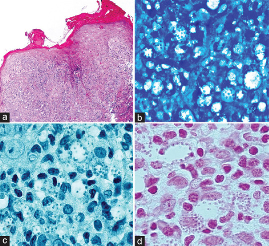 Self-administration of herbal treatment for periocular cutaneous leishmaniasis: A case report and systematic review.