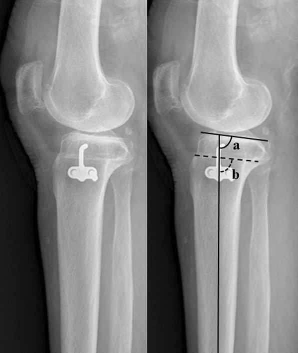 Surgical accuracy of coronal and sagittal alignment in conventional closed-wedge high tibial osteotomy after computer-assisted surgery experience.