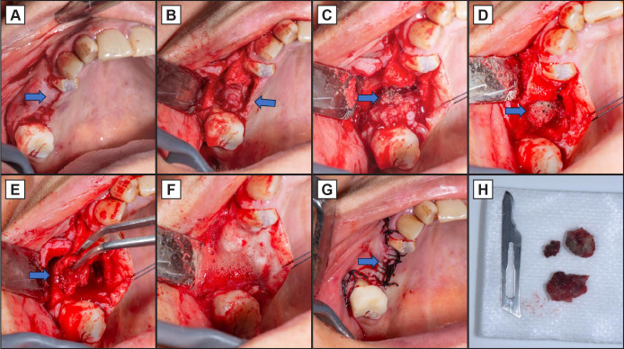 A Case Report of Ibandronic Acid Induced Non-Exposed BRONJ Involving the Maxillary Sinus.