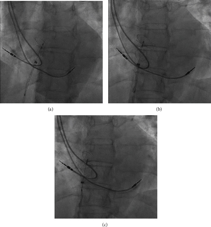 Pacemaker Lead Entanglement during Interventional PFO Occlusion: Salvage Using a Sizing Balloon.