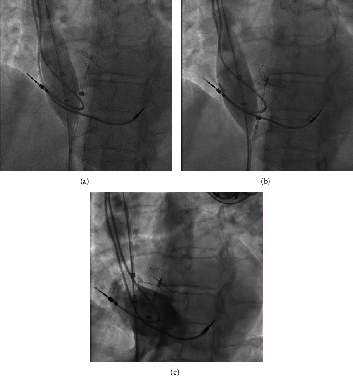 Pacemaker Lead Entanglement during Interventional PFO Occlusion: Salvage Using a Sizing Balloon.