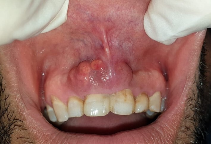 Rosai-Dorfman disease of the oral cavity.