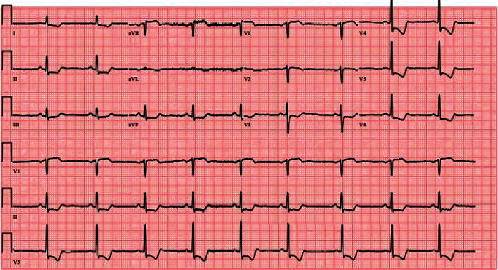 Spontaneous Extensive Type A Aortic Dissection in an Older Female with No Risk Factors: A Rare Clinical Presentation.