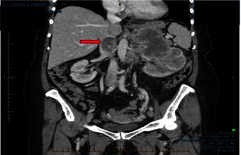 Migration of an Inferior Vena Cava Tumor Thrombus during Renal Cell Carcinoma Resection.