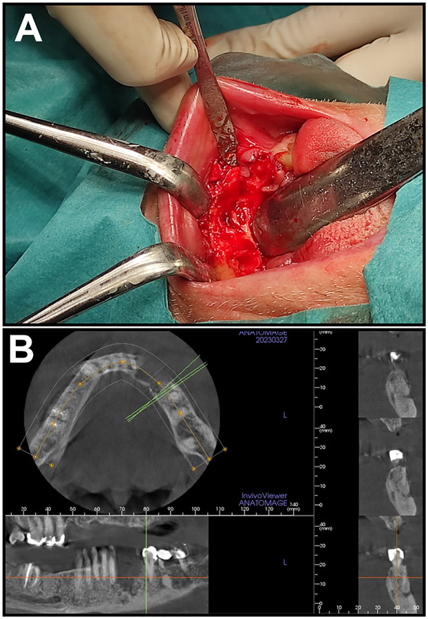 Role of Actinomyces spp. and related organisms in the development of medication-related osteonecrosis of the jaw (MRONJ): Clinical evidence based on a case series.