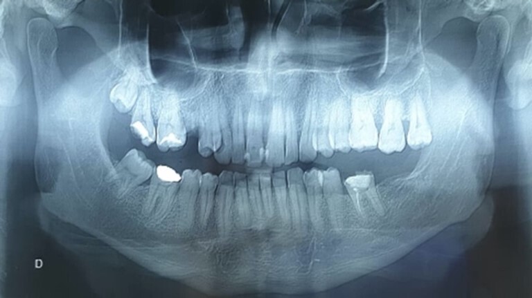 Rosai-Dorfman disease of the oral cavity.