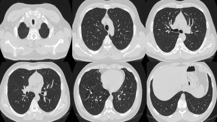 Diffuse alveolar hemorrhage following inhaled sevoflurane: A rare complication of inhalational anesthesia.