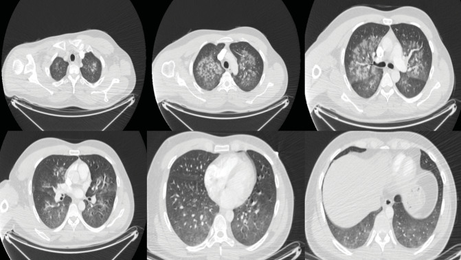 Diffuse alveolar hemorrhage following inhaled sevoflurane: A rare complication of inhalational anesthesia.